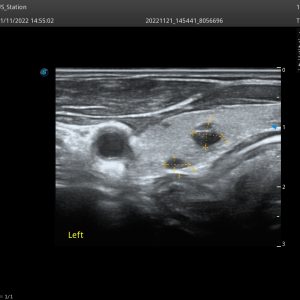 12L B THYROID for SonoScape 12L B Ultra HD Broadband Linear Ultrasound Probe
