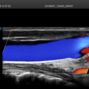 SonoScape 12L A Ultra HD Broadband Linear Ultrasound Probe