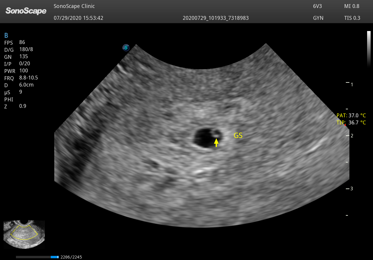 SonoScape 6V3 HD Endocavity Ultrasound Probe