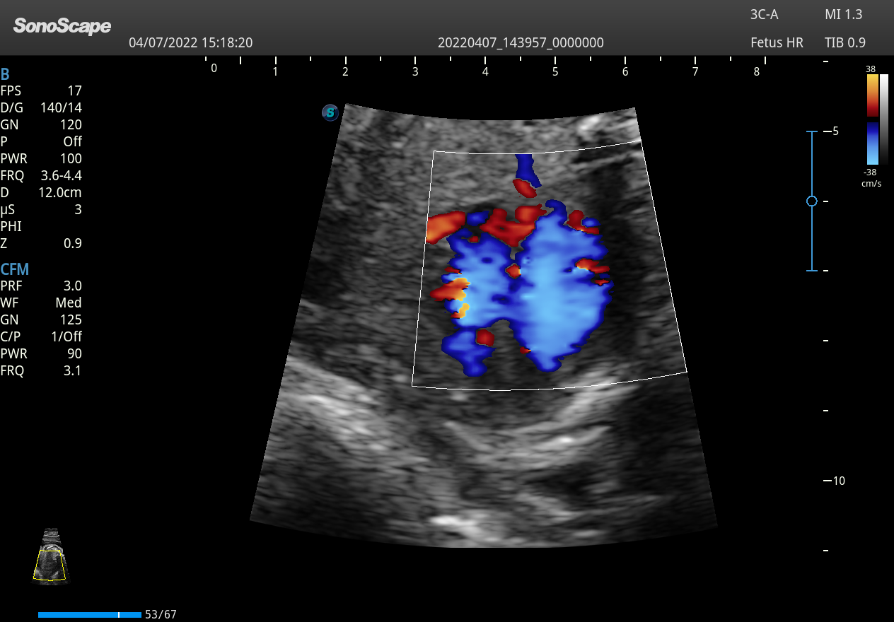 3C A Fetal cardiac 4CH Color 1 for HD Convex Ultrasound Probe 3C A