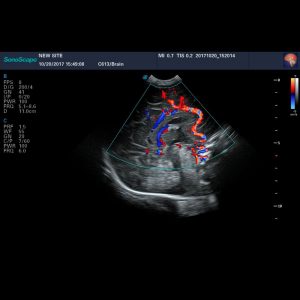 SonoScape C 613 HD Micro Convex Probe for Transcranial Scanning