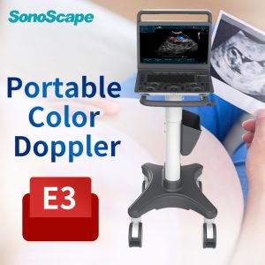 SonoScape E3 Portable Colour Doppler Ultrasound System