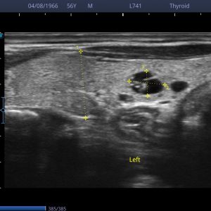 L741 THYROID WITH MEASURMENTS P20 for SonoScape L741 Linear Ultrasound Probe 4–16 MHz for E1/E2/E3