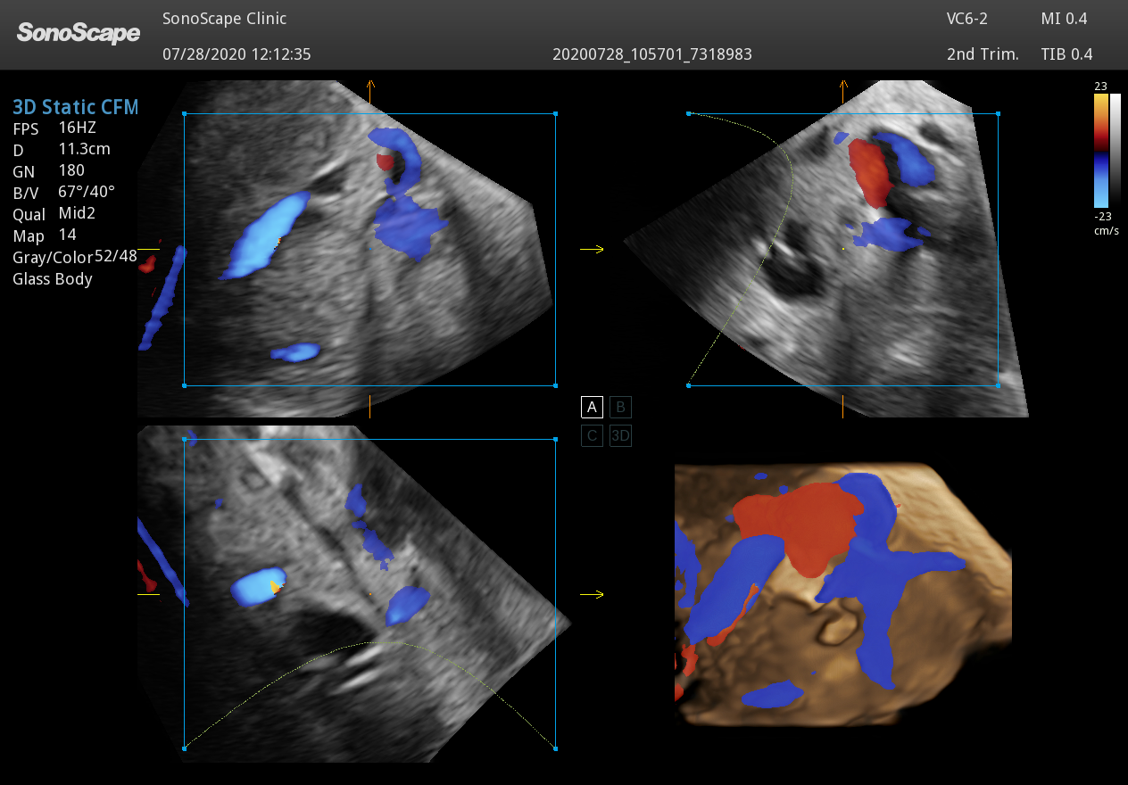 Liver Cyst 4D (3) for SonoScape VC6 2 4D Volume Ultrasound Probe