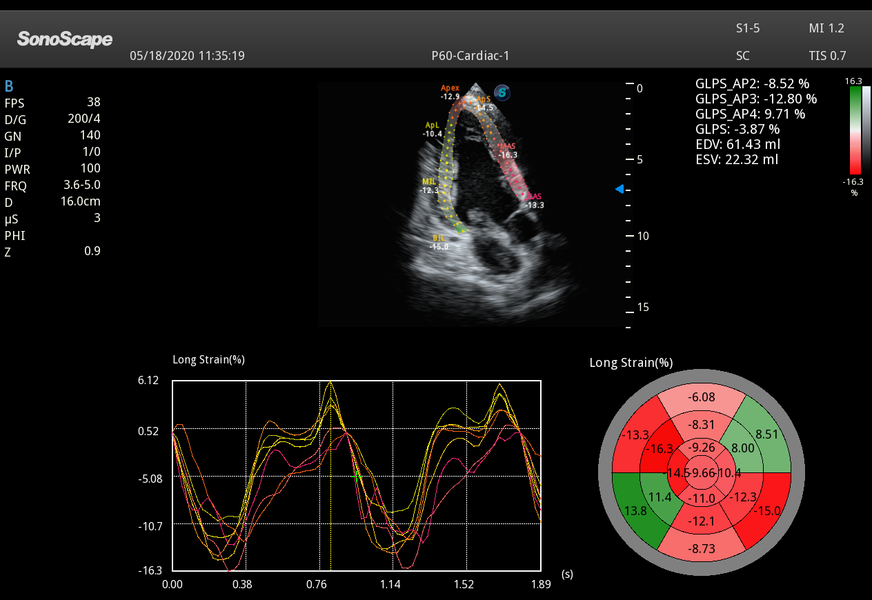S1 5 Myocardial Quantitative Analysis for SonoScape S1 5 Single Crystal Phased Array Ultrasound Probe
