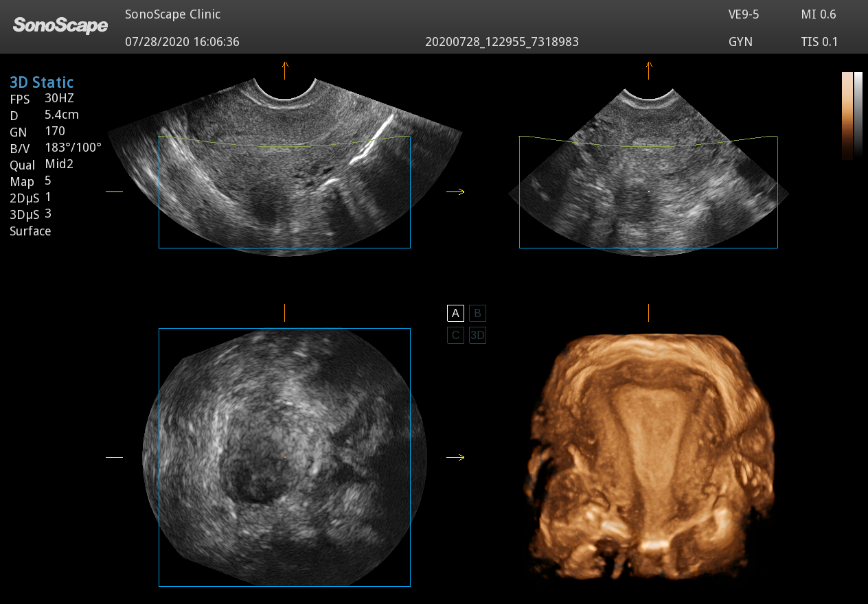 Uterus 4D for SonoScape VE9 5 3D/4D Volume Transvaginal Ultrasound Probe