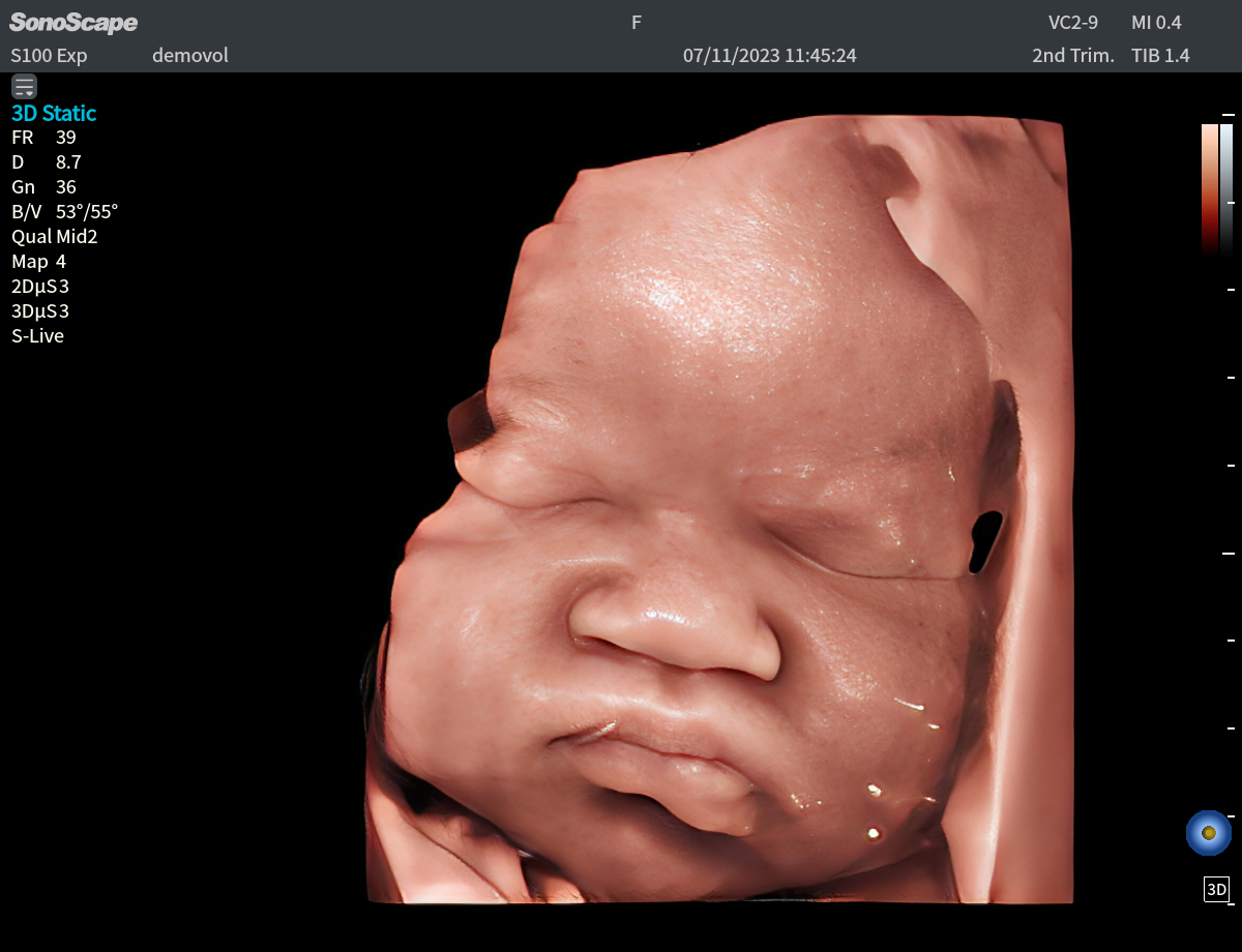 4.33D睿颜成像 1 for SonoScape AI Ultrasound System for Gyn/OB S70i Fenix