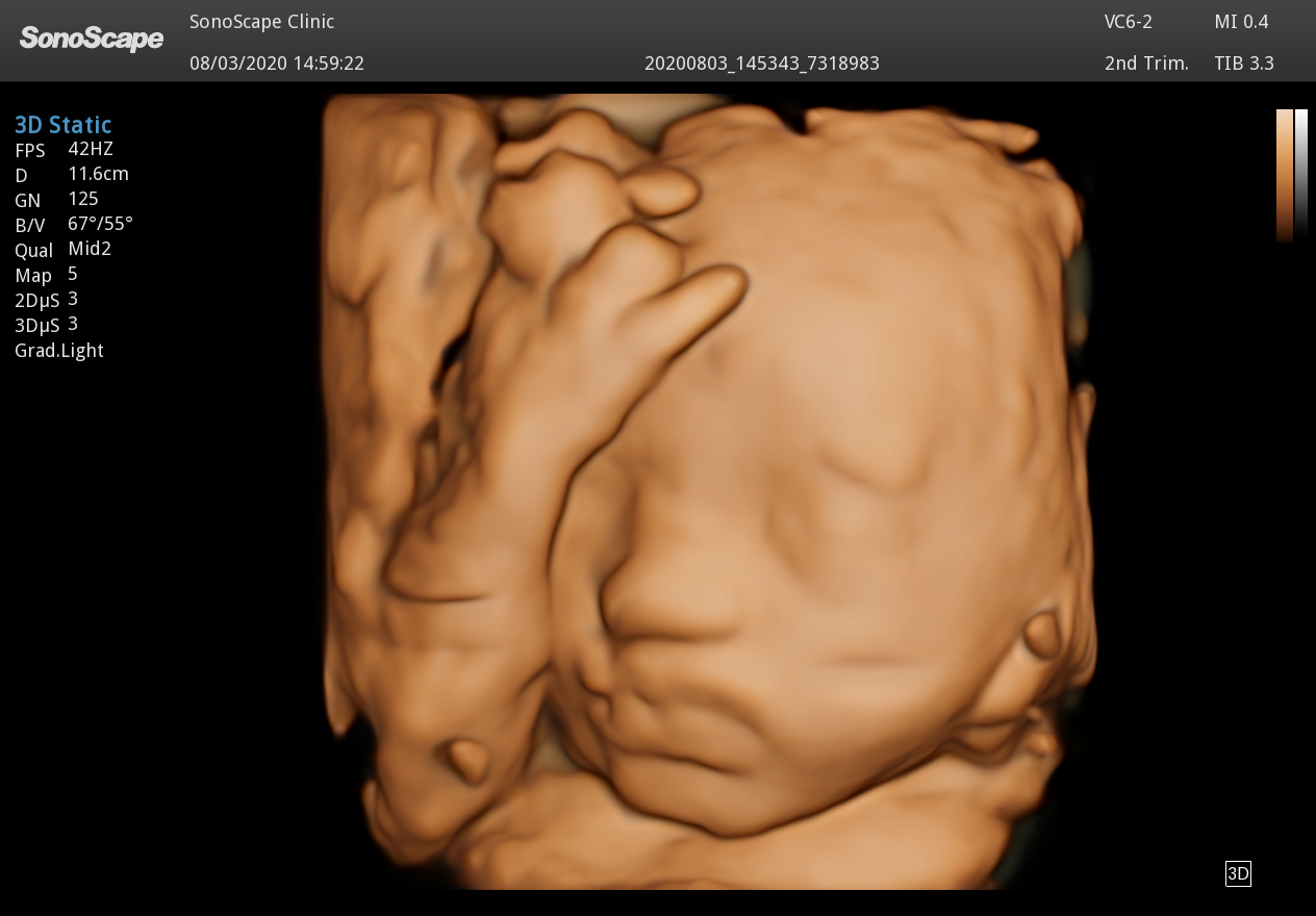 SonoScape P40 Elite AI Ultrasound System for Obstetrics and Gynaecology