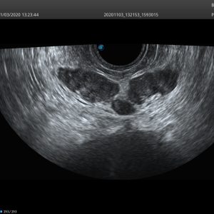 SonoScape BCL10 5 Bi Plane Urology Ultrasound Probe
